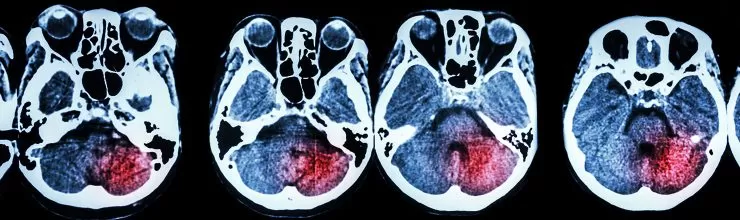 An Overview of Vascular Dementia